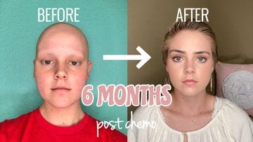 Tips for Post-Chemo Hair Growth